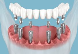 How Can I Ensure My Dental Crowns Last Longer?