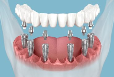 How Can I Ensure My Dental Crowns Last Longer?