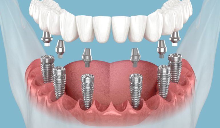 How Can I Ensure My Dental Crowns Last Longer?